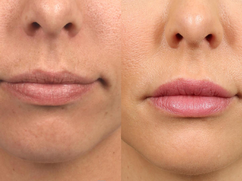 Lip Enhancement
